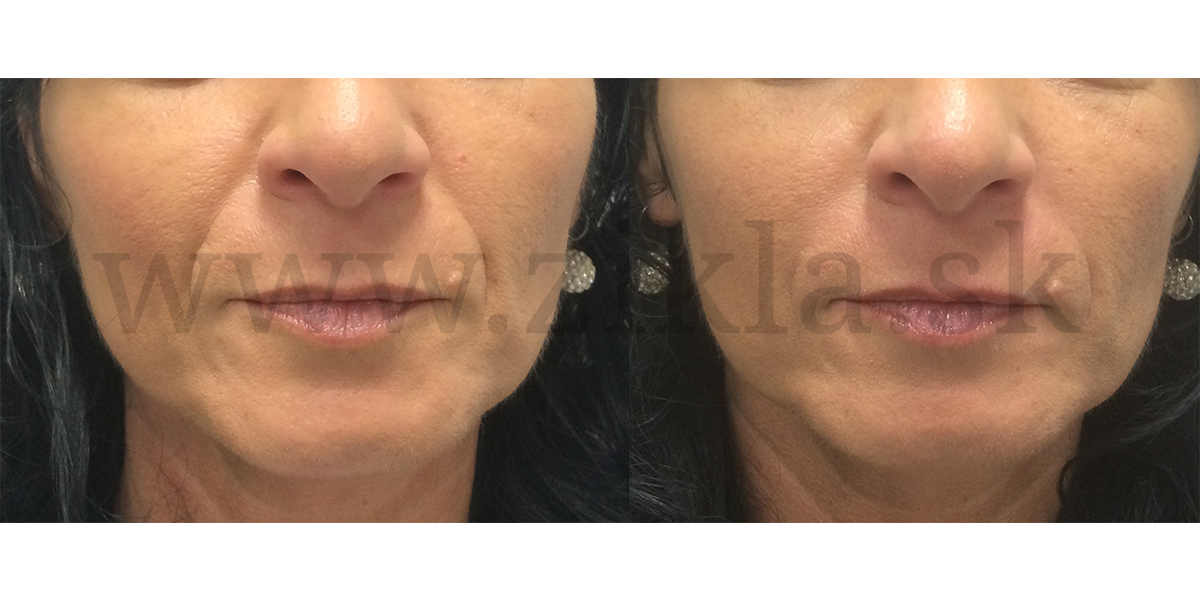 vypln nosovoustnych ryh kyselinou hyaluronovou zikla plasticka chirurgia omladenie tvare