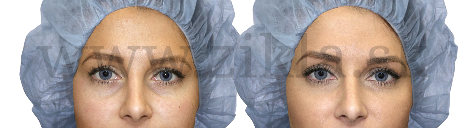 odstranenie kruhov pod ocam vodotlac zikla plasticka chirurgia kyselina hyaluronova banska bystrica plasticke operacie exteticke zakroky plasticky chirurg 