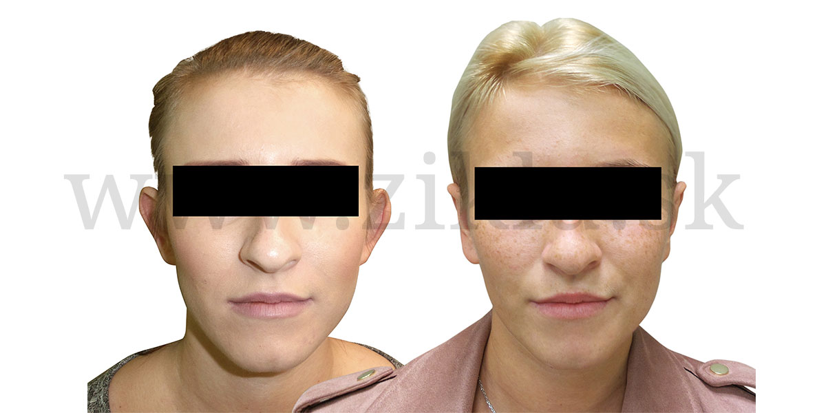 palsticka-operacia-usi-otoplastika-banska-bytrica-zikla jednodnova plasticka chirurgia esteticka chirurgia plasticke operacie 