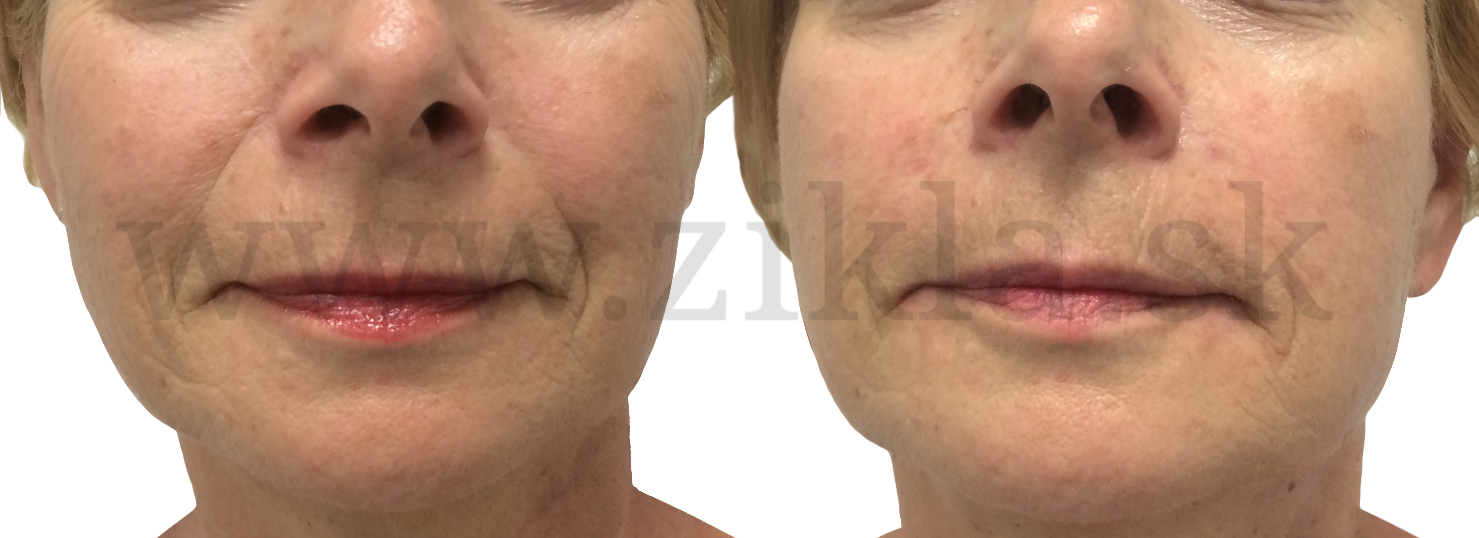 Po aplikácii 1 ml kys. hylaurónovej PLASTICKA CHIRURGIA ODTRANENIE VRASOK PLASTICKY CHIRURG mudr iVAN ziKLA Banská bystrica vypln vrasok