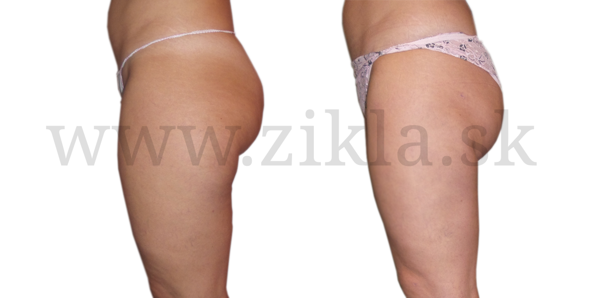 Liposukcia-bokov,-stehien-a-kolien-po-6-týždňoch.bokpng