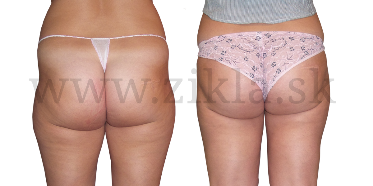 Liposukcia-bokov,-stehien-a-kolien-po-6-týždňoch.bokpng