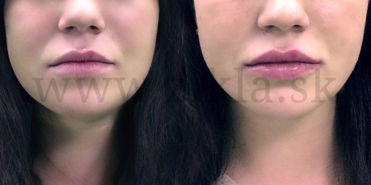 zvacsenie pier -Po aplikácii 1 ml kys. hylaurónovej PLASTICKA CHIRURGIA ODTRANENIE VRASOK PLASTICKY CHIRURG mudr iVAN ziKLA Banská bystrica vypln vrasok