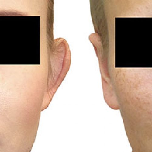 titulna fotografia palsticka-operacia-usi-otoplastika-banska-bytrica-zikla jednodnova plasticka chirurgia esteticka chirurgia plasticke operacie