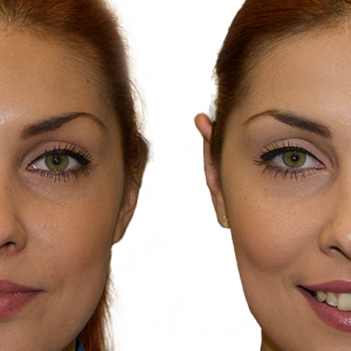 titulna fotografia palsticka-operacia-usi-otoplastika-banska-bytrica-zikla jednodnova plasticka chirurgia esteticka chirurgia plasticke operacie