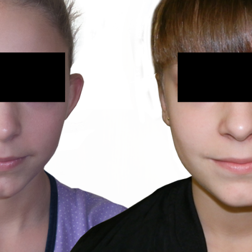 palsticka-operacia-usi-otoplastika-banska-bytrica-zikla jednodnova plasticka chirurgia esteticka chirurgia plasticke operacie